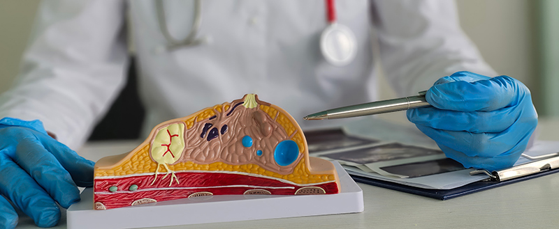 Gynecomastia doctor having consultation with patient with anatomy model