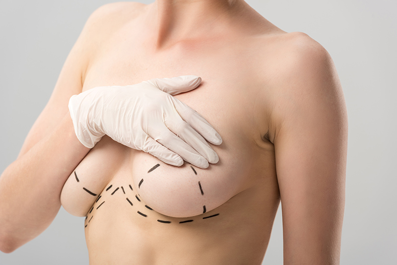 Measurements for a breast augmentation surgery